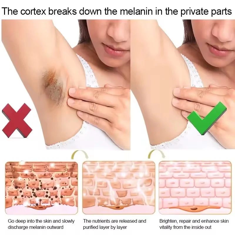 멜라닌 제거 니코틴아미드 브라이트닝 크림 다크 스킨 효과적인 허벅지 내부 표백제 개인 부품 브라이트닝 크림